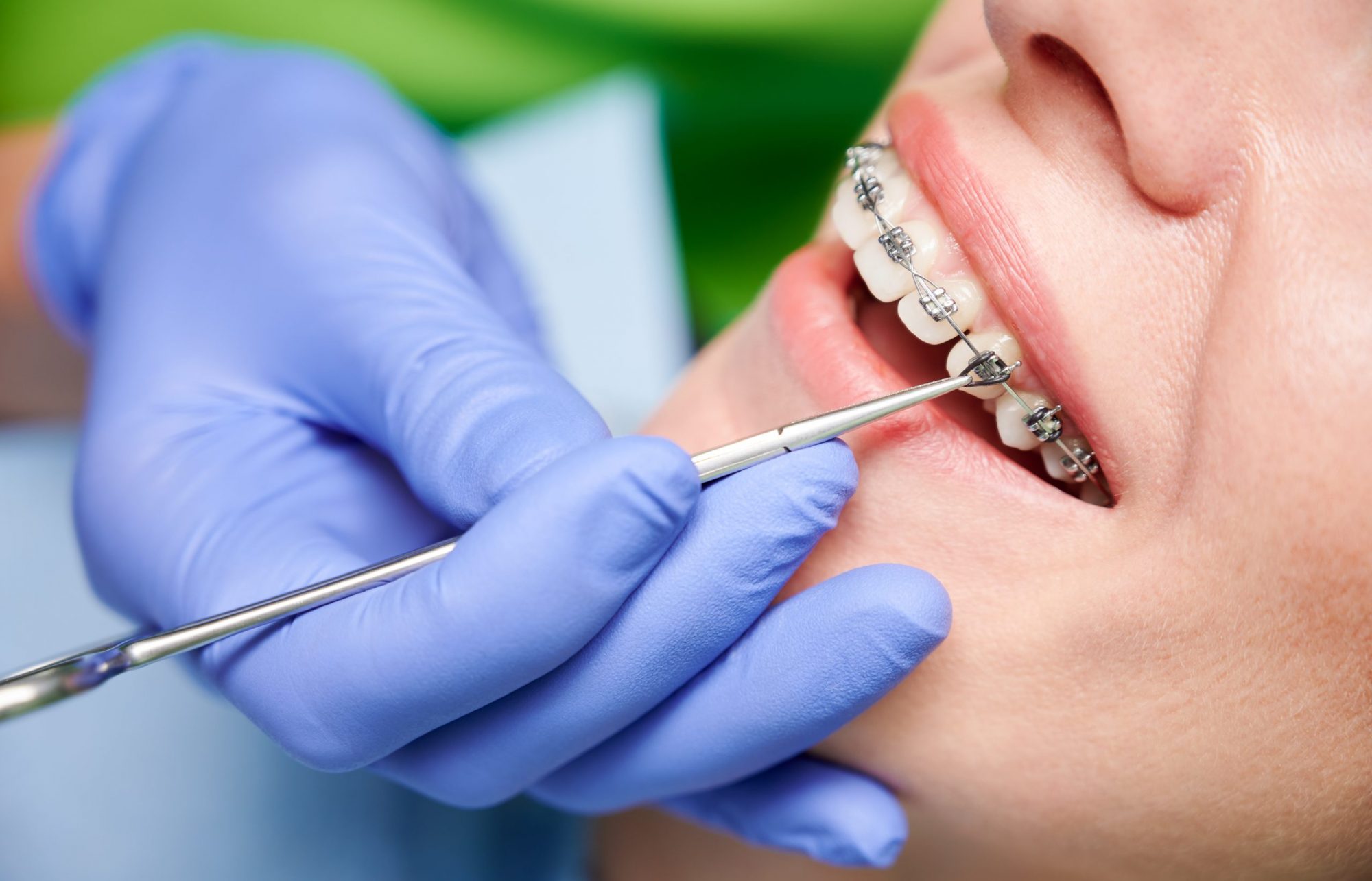 Orthodontist hands placing braces on woman teeth.